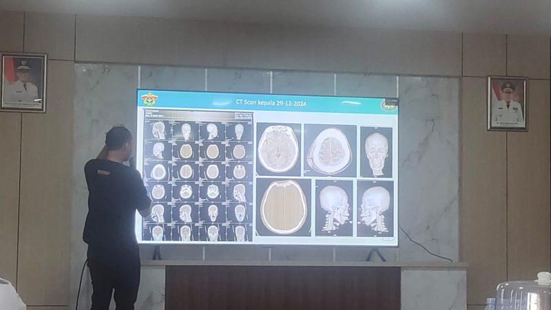 Proses operasi otak ditampilkan di layar yang dilakukan oleh pihak Rumah Sakit (RS) dr. Hasri Ainun Habibie Parepare, Sulawesi selatan